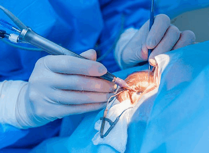 Cataract Surgeries