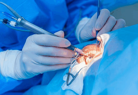 Cataract Surgeries